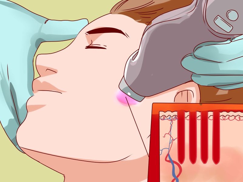 Items To Bear In Mind When Selecting Laser Resurfacing Treatment