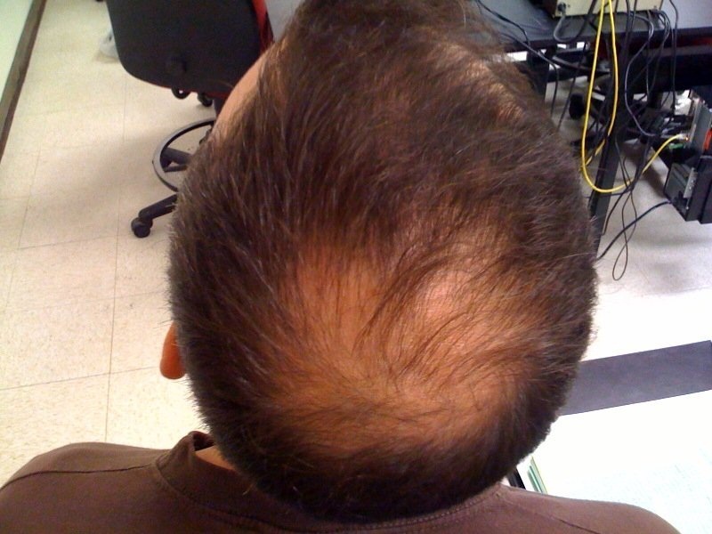 Steps You Can Take To Prevent Hair loss