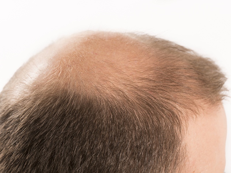 Can Men Experience Traction Alopecia?