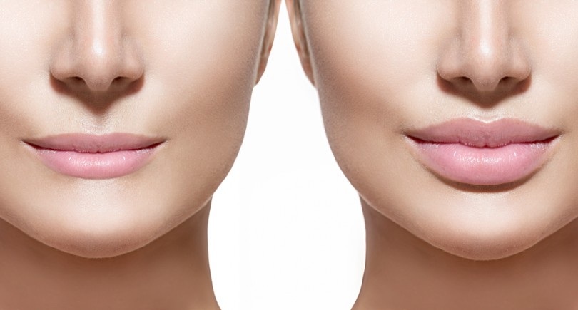 Looking at Getting Lip Fillers?