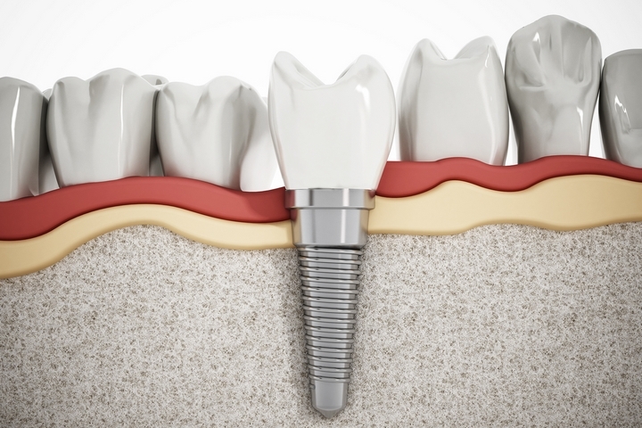Best Foods to Eat with Invisalign