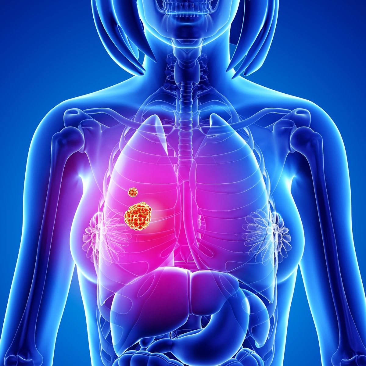 Lung Cancer: What Causes It and the Common Symptoms?