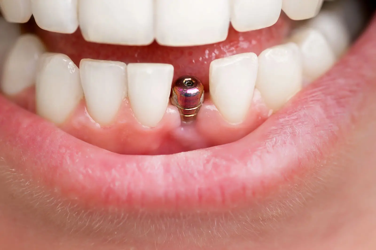 A comprehensive guide to understanding dental implant restoration