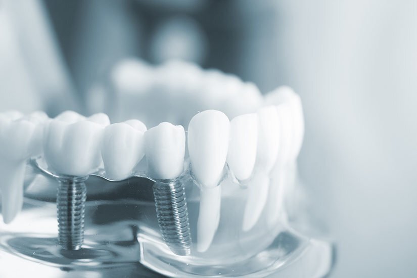 Why Investing In Dental Crowns Is Beneficial For Long-Term Oral Health
