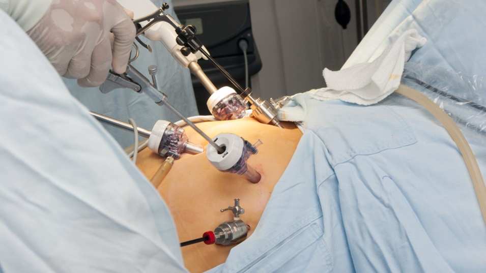Gastric Sleeve