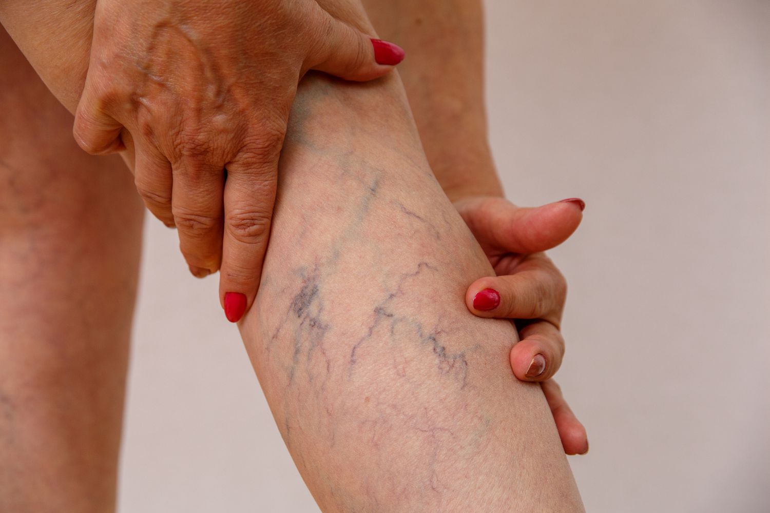 Tips to Manage Your Varicose Veins 
