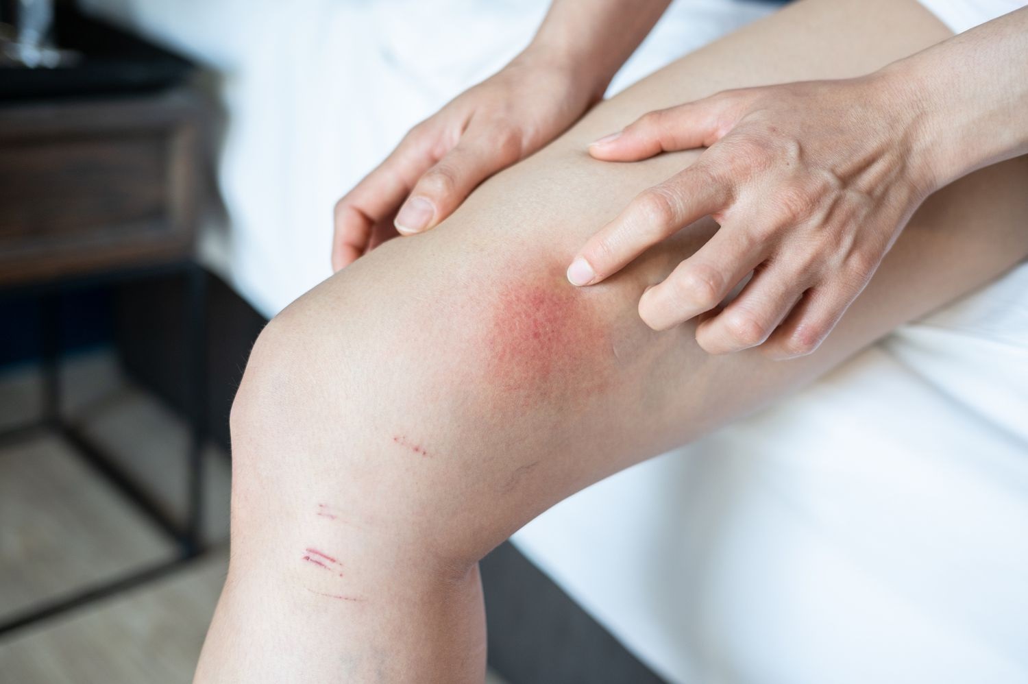 How do you treat chafing?