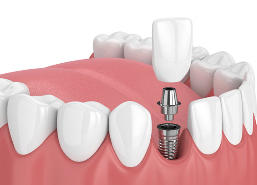 What You Should Know about the Dental Implant Procedure