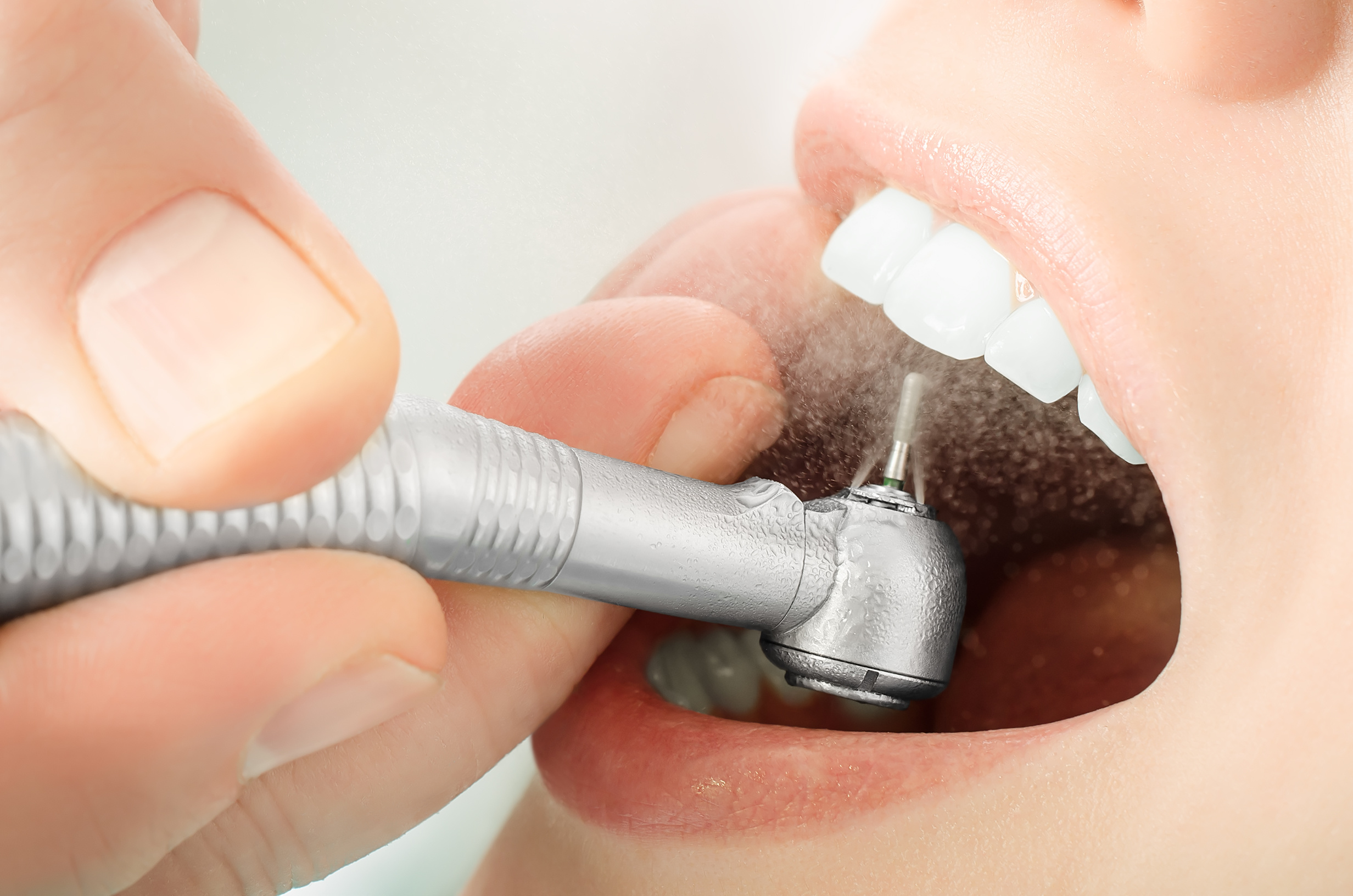 Tips for Choosing the Best Tooth Restoration Treatment