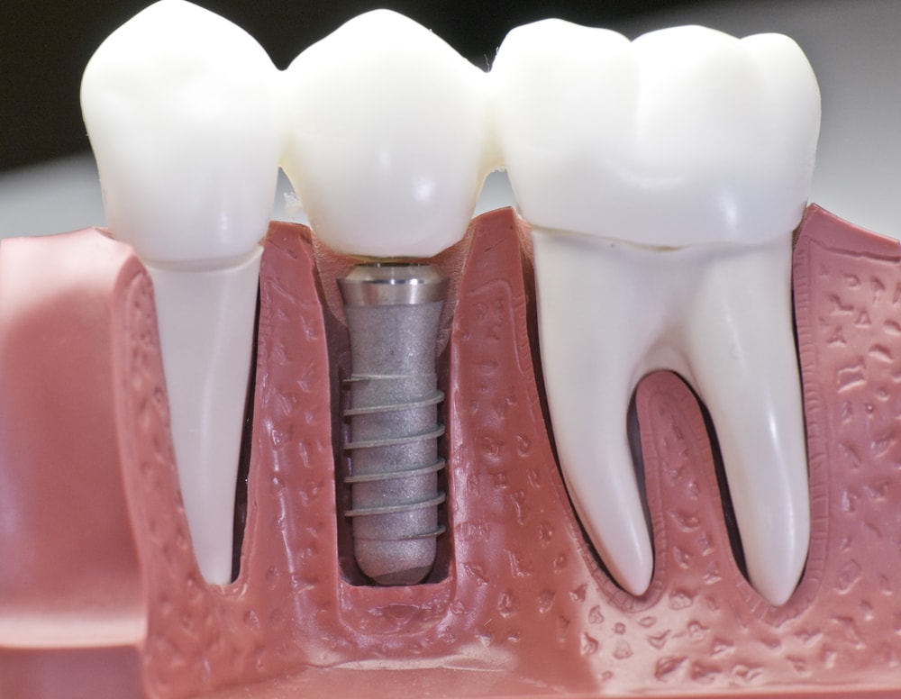 Permanent Teeth Replacements: Your Guide To Dental Implants