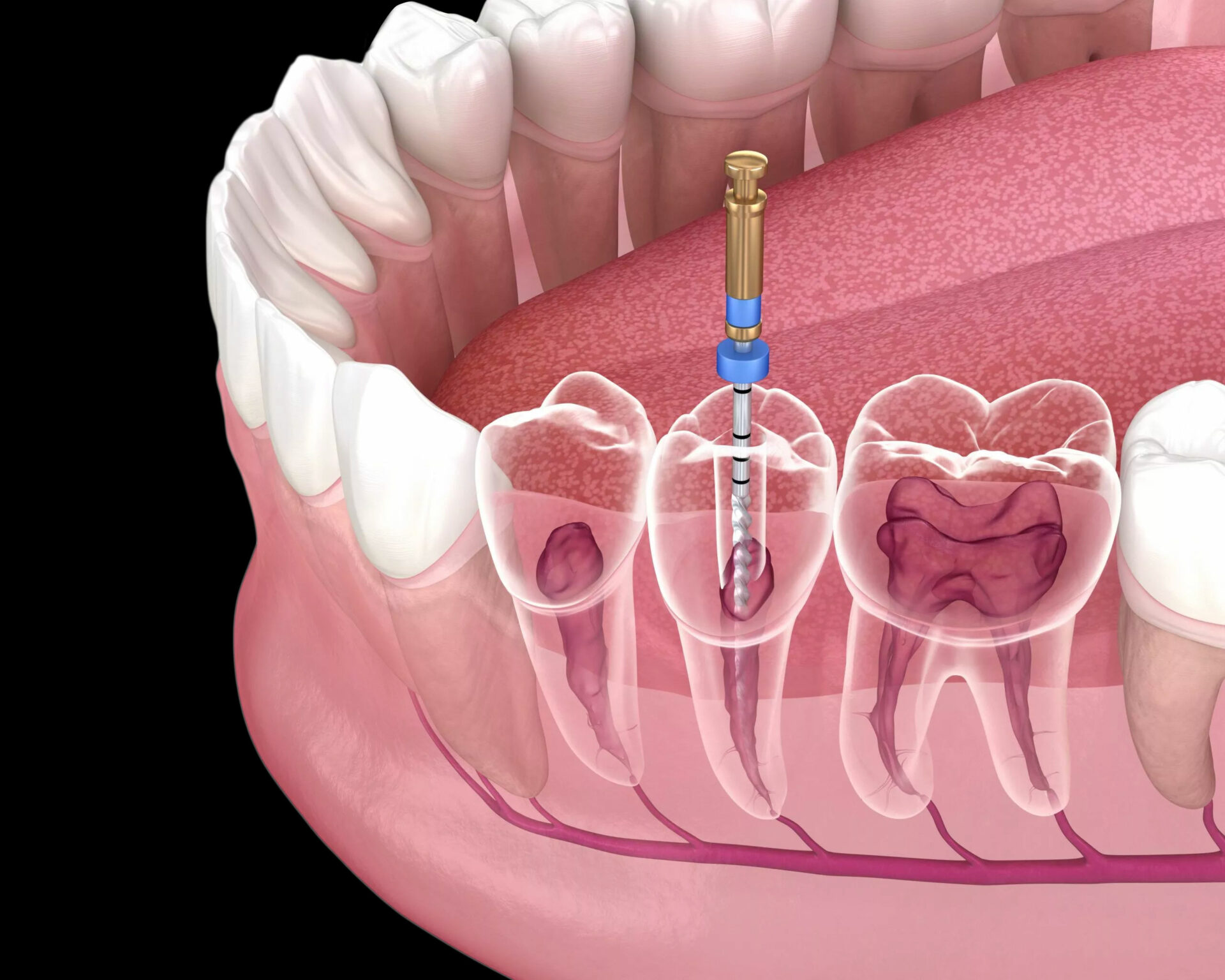 What is the Warning Sign That You Need a Root Canal? 
