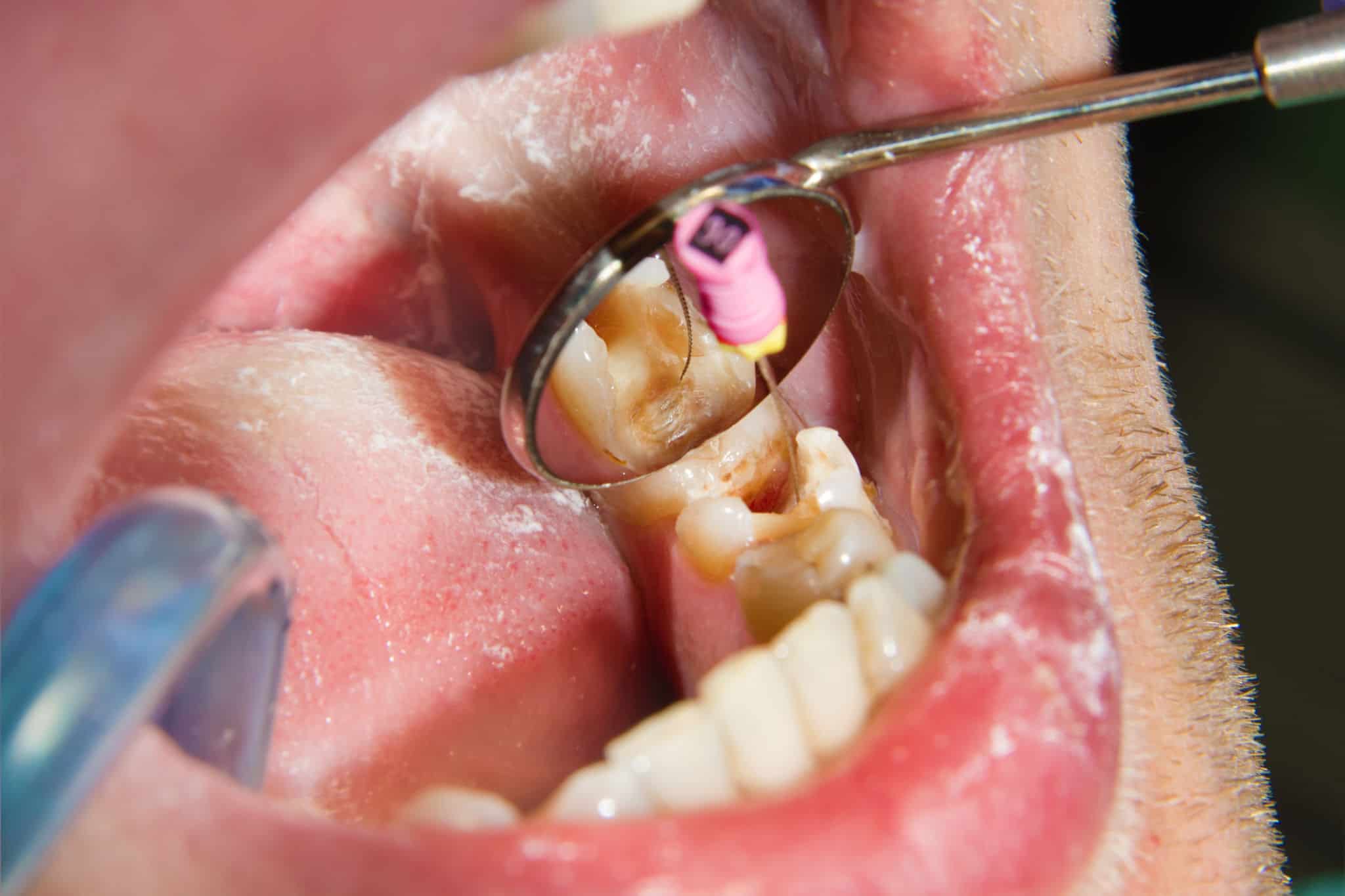 Decoding Root Canal Treatment: Facts and Benefits