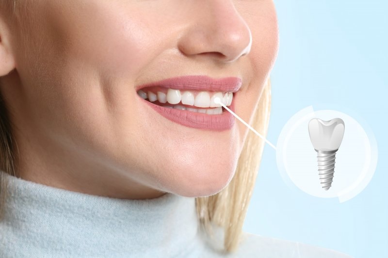 Are There Any Lifestyle Adjustments Necessary After Getting Dental Implants?
