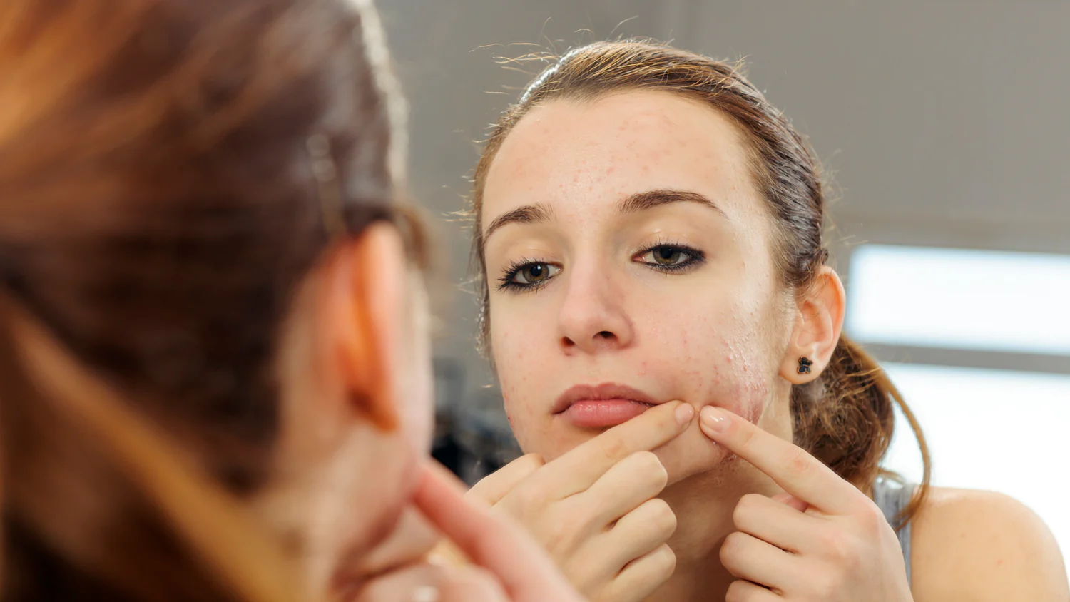 Understanding and Treating Acne Marks (暗瘡印) and Scars (凹凸洞 and 暗瘡疤)