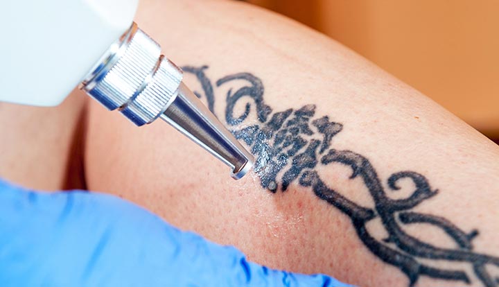 Why does modern laser removal differ from outdated tattoo removal methods?