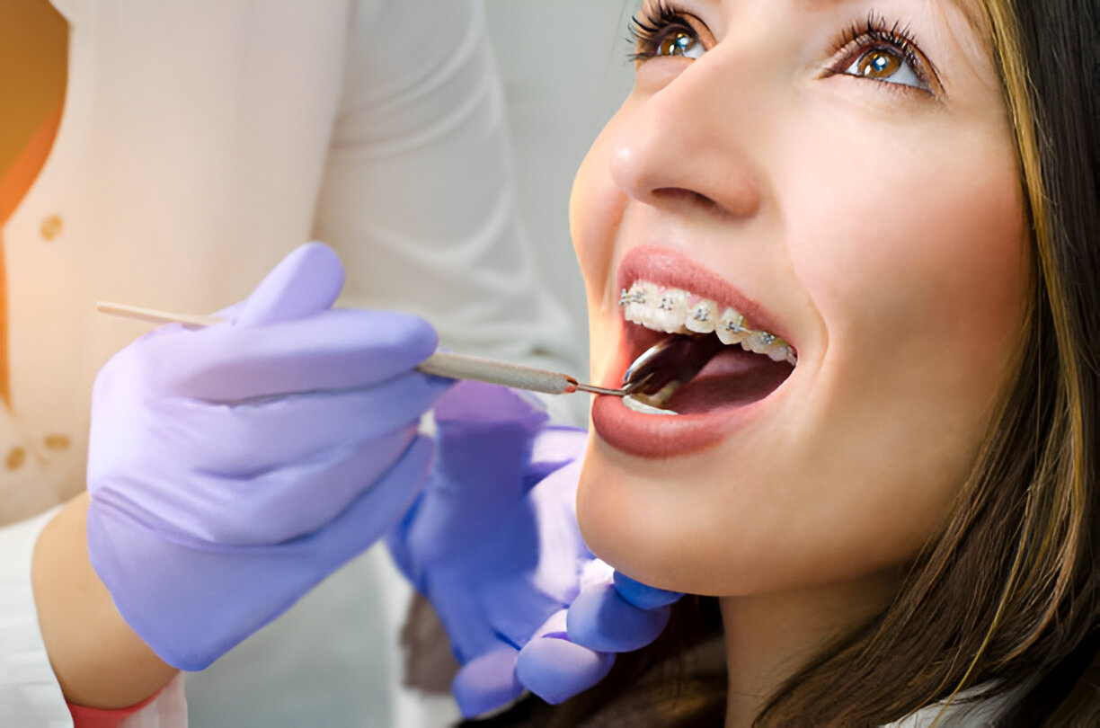The Importance of Adult Braces