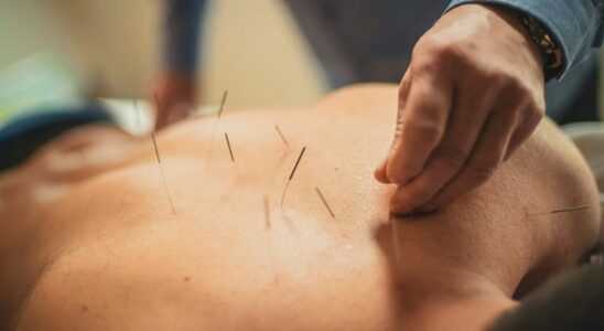 Benefits of Acupuncture