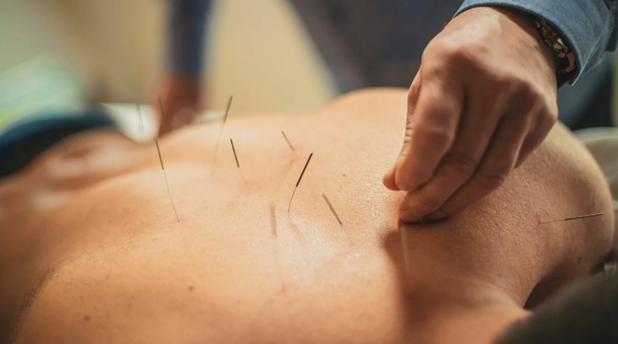 Benefits of Acupuncture