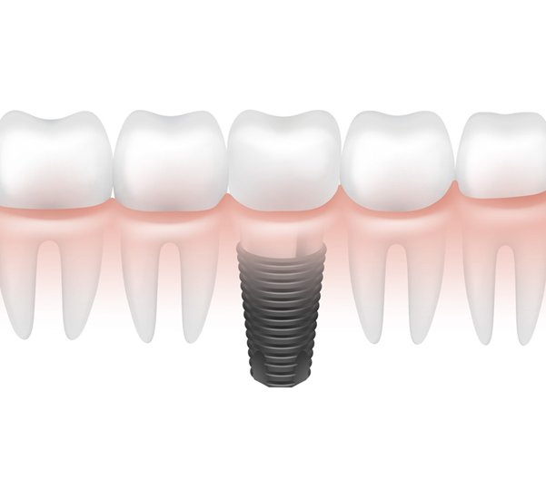 How Dental Implants Improve Speech and Chewing Function