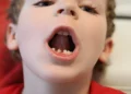 Signs Your Child May Need a Pulpotomy