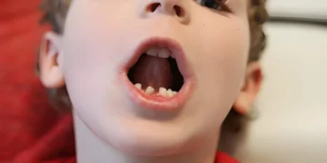 Signs Your Child May Need a Pulpotomy