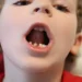 Signs Your Child May Need a Pulpotomy