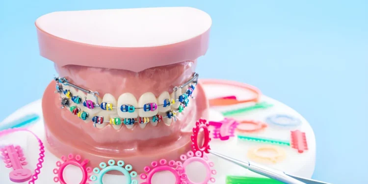 Which is Right for You – Damon Braces or Traditional Braces?